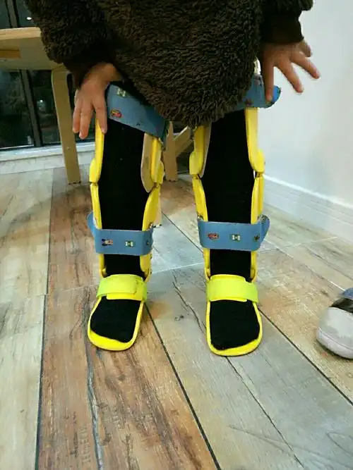 一岁半宝宝x型腿怎么办?