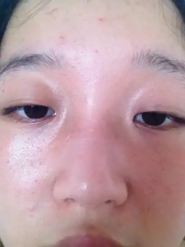 问:我的鼻子老是黑黑的一块 有什么方法可以去掉嘛?