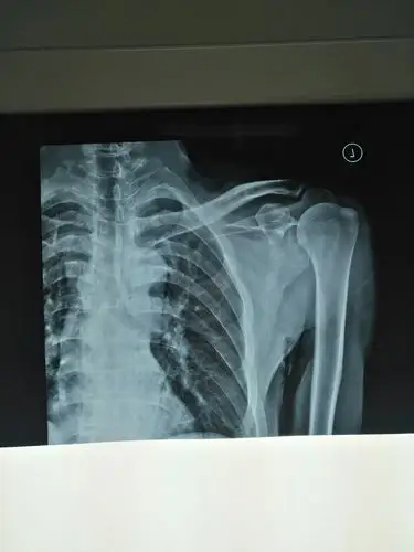 关节活动受限,疼痛.诊断:肩袖损伤,腋神经损伤  病案号:1907