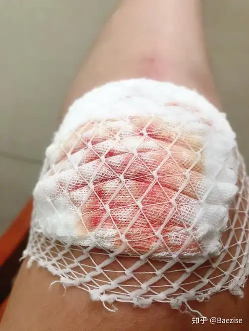 骑车侧翻膝盖摔伤破皮,怎么处理伤口,怎样才能不留疤? - 知乎