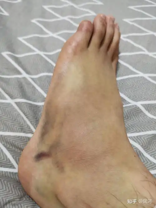 宁折不弯——左脚第五跖骨基底粉碎性骨折 随记三个月 - 知乎