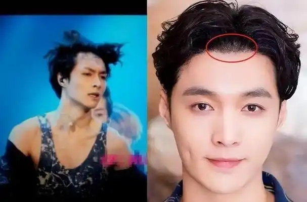 秃发,常常不惜花费精力和金钱,要么戴上假发片,要么通过植发来解决