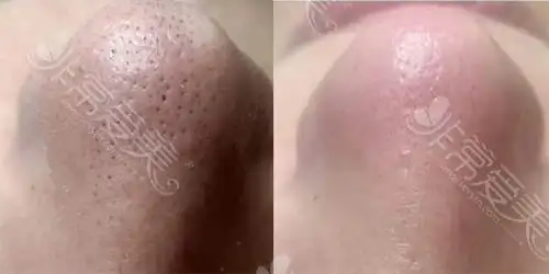 同款草莓鼻改善后对比↑毛孔粗大与油脂分泌是一个相辅相成的关系