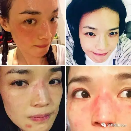 舒淇拯救敏感肌到底用了什么好办法?_皮肤