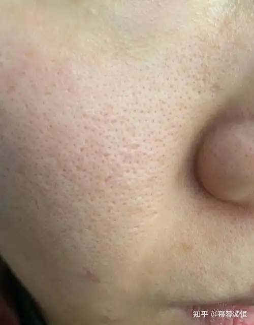 哪些护肤品可以缩毛孔呢鼻子毛孔粗大怎么修复