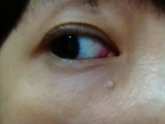 有很多年了,不痛不痒,但有点大,影响美观了.