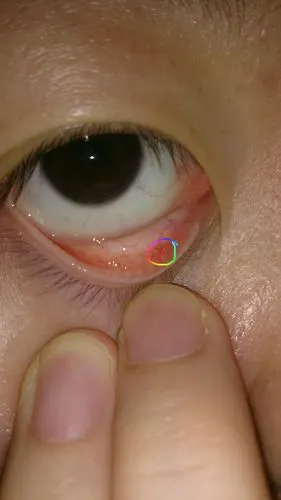 下眼皮内长了一个针尖大小的白疙瘩,不知道是什么?