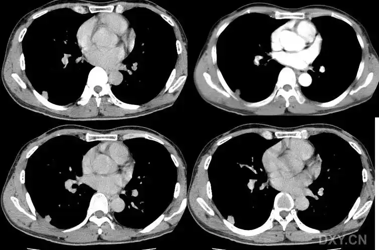 【读片】右下肺结节ct平扫 增强,病理结果已公布. [病例帖]