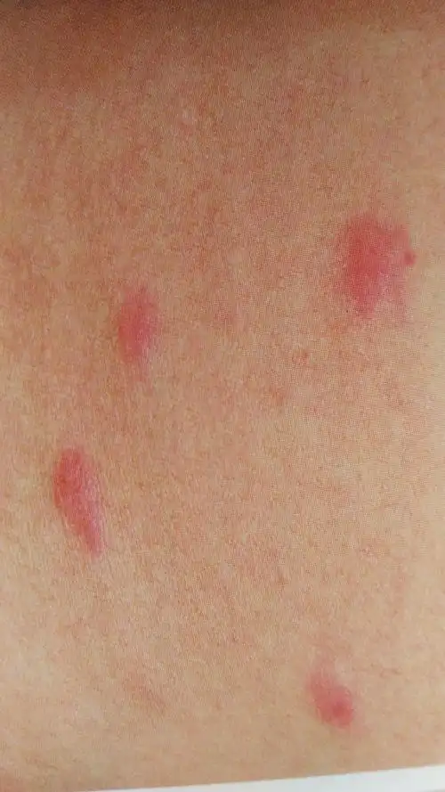 儿童常见季节性过敏性皮肤病-丘疹性荨麻疹