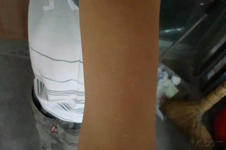 看图诊断16特发性点状白斑