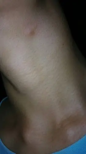 脖子莫名其妙起了个小包,感觉有点硬,是什么东西,应该擦什么药