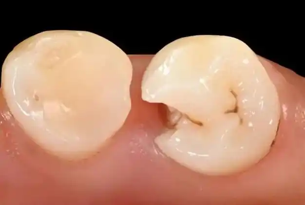 使用"biobulk"技术进行直接盖髓术,治疗深层龋齿病变