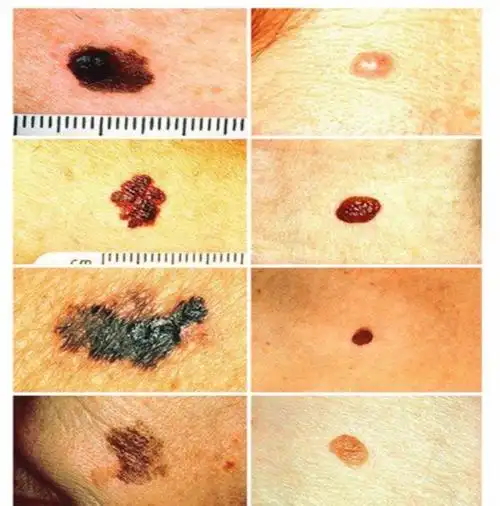 黑色素瘤_症状_症状表现_预防_如何预防 - 好大夫在线