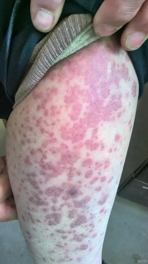 看图识病 - 皮肤及性传播疾病讨论版 - 爱爱医医学论坛