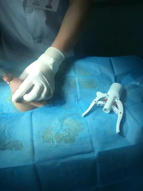 实图一一包皮环切1