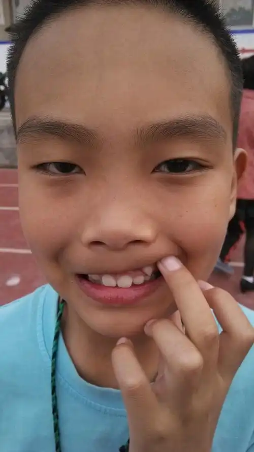 我家小孩现已十岁零四个月,男孩,在其两颗犬牙上面的牙龈处各长出两