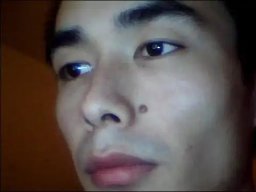 大家认为鼻子上的这颗痣有必要取吗?取的话什么方法比较好?