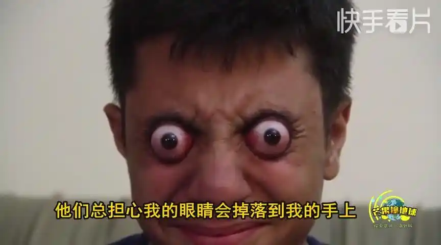 神奇巴基斯坦男孩眼球能外翻爆红网络欲挑战吉尼斯世界纪录