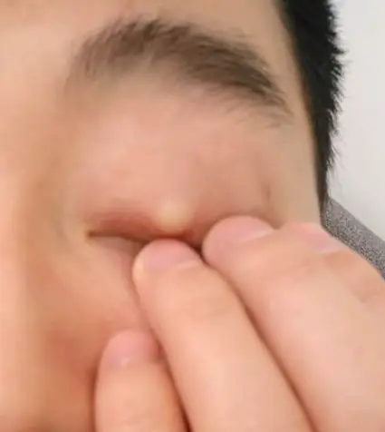 标签霰粒肿怎么治疗