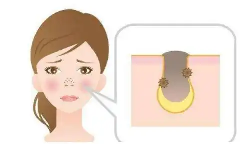 总是毛孔粗大不知道原因?帮你找出6个诱因-凯风网