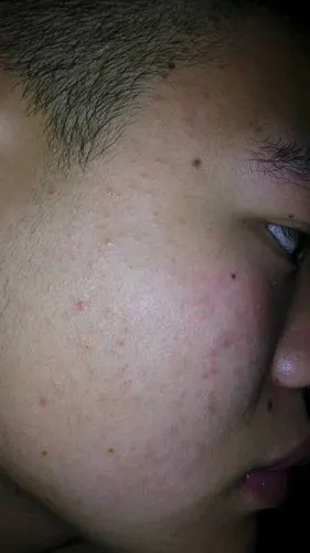 脸上两部皮肤显得干燥好像过敏一样红红的