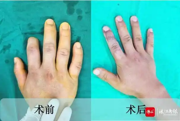 手指再造实例分享手指再生梦佛山手指再造免费咨询
