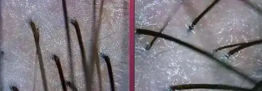 他们也有烦恼,那就是会经常感觉到头皮发痒,头皮屑多,在毛囊检测中