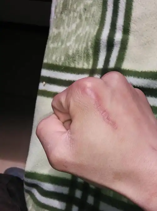 看看我手上这个疤影响征兵吗?