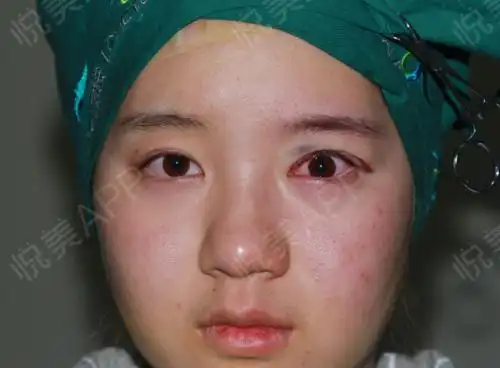 第一次来这里写日记记录我上睑下垂矫正手术恢复过程今天刚刚做完手术