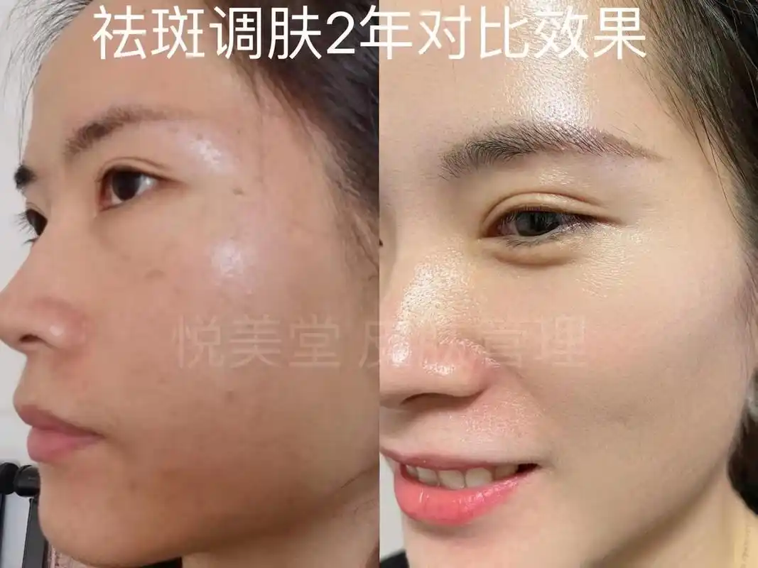 我的蓝闺蜜,来咯来咯!蓝闺蜜祛斑调肤2年对比效果[666][666][666]