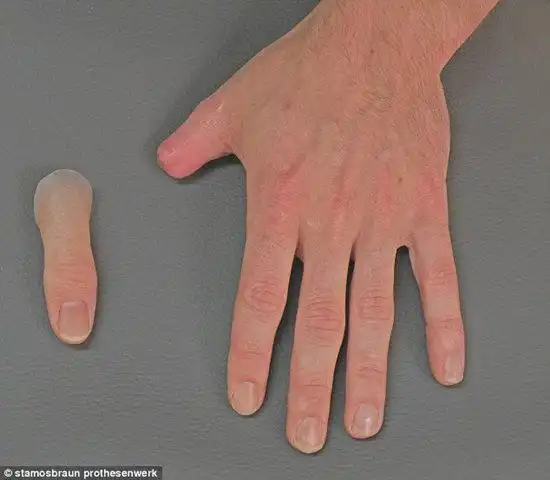 "超仿真"假肢难辨真假 外观好看活动差(图)