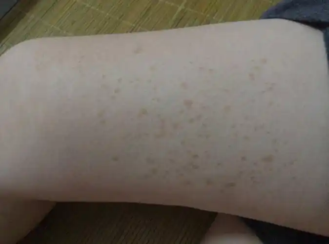 6 2010-07-04 我两小腿上出现血红色的斑点不痛不痒, 5 2009-01-01