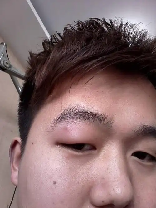 我左眼皮一大早起来就肿了,这是怎么回事?