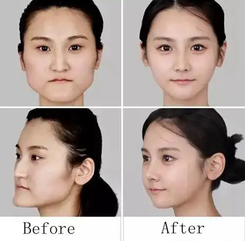 脸部整形前后对比案例