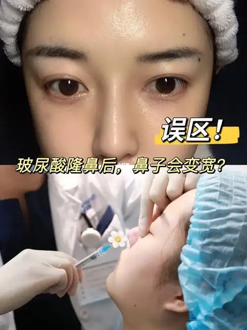 从而一直在纠结要不要用玻尿酸垫山根,作为一个鼻子打过玻尿酸的人,来