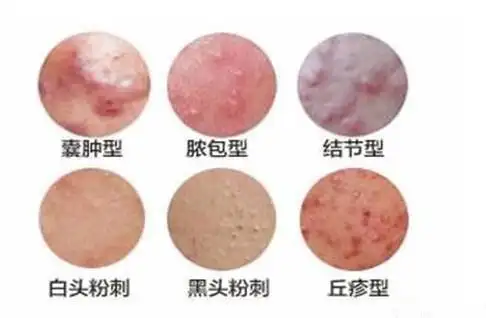 痤疮