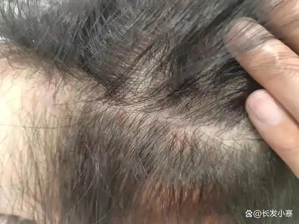 脱发头皮屑头皮人的第二张脸还不重视吗