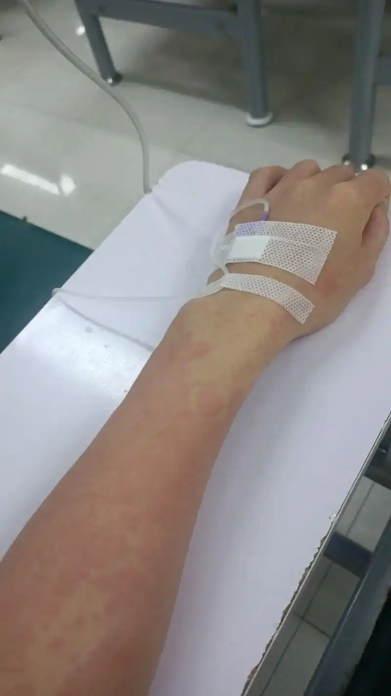 过敏性荨麻疹.过敏性荨麻疹突然来袭,身体差点招架不住,还好自 - 抖音