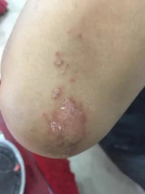 一开始是手肘关节处开始出现如图然后开始手上有小面积出现