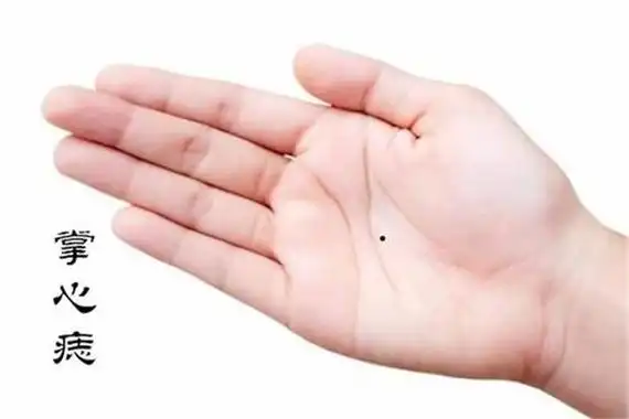 男孩左手掌心有痣