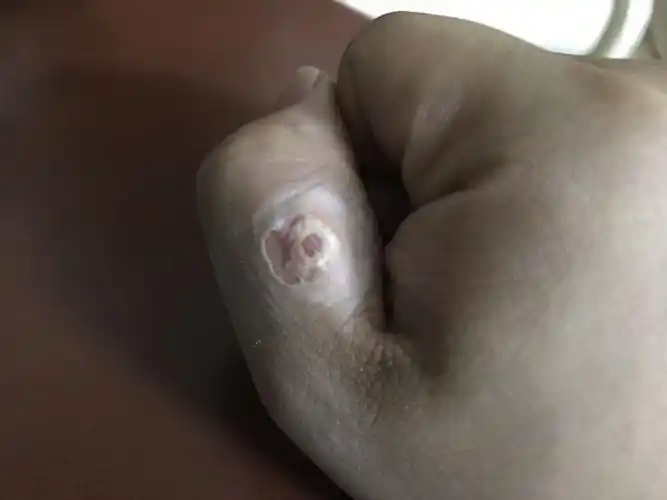 这样的情况鸡眼算脱掉了么?