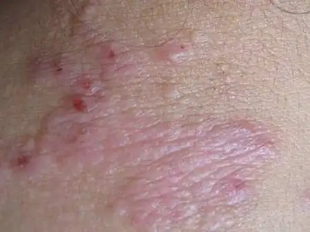 过敏性皮炎注意哪些护理