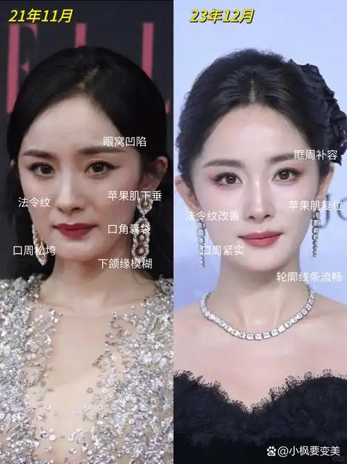 扒了杨幂近一年的口周变化,从面部松垮到现在平整度提升,不愧是内娱
