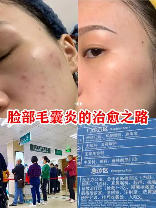 先治痘97因为我的是属于真菌类感染引起的毛囊发炎,从而导致痘痘