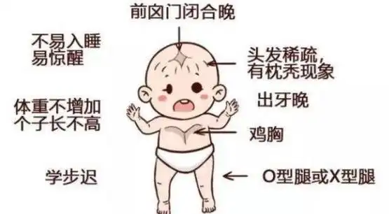 小孩子的佝偻病的症状有哪些快来看看这些症状早预防