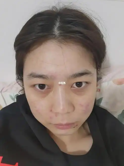 慎入,后面长痘照片加素颜原相机有点吓人…_痘痘_美妆_护肤_护肤其他