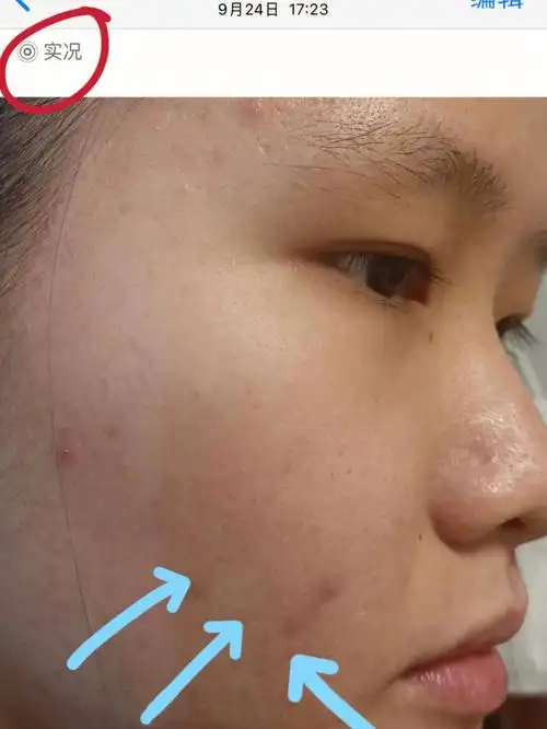 一不小心去痘印成功上岸啊啊啊啊啊