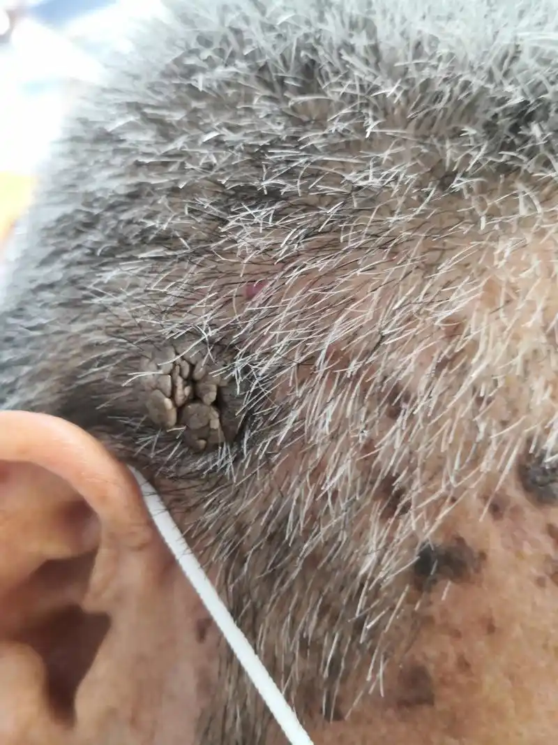 头皮疣状物激光治疗去除可以.