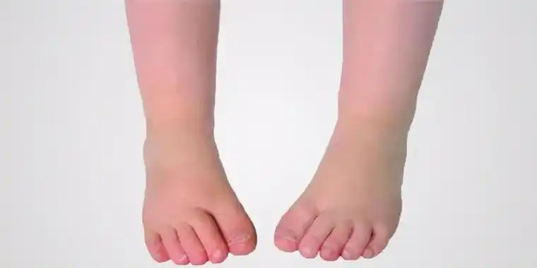 孩子走路内八字怎么回事孩子走路有点内八字有好方法改变吗