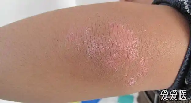 皮肤病双肘部皮疹一年